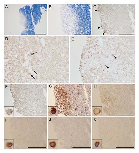 ofgfap|Glial Fibrillary Acidic Protein Autoimmunity 